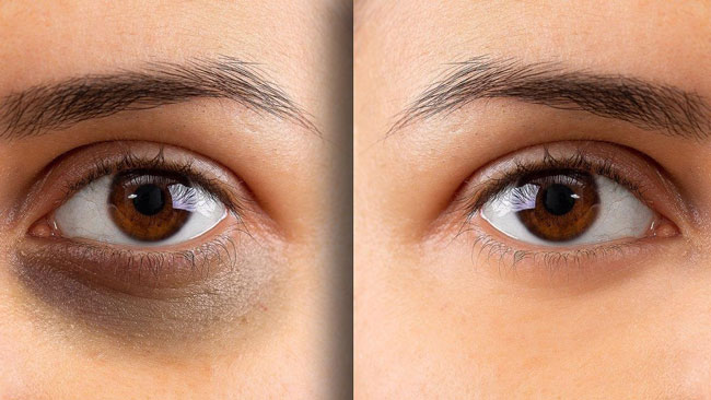 Tiêm Mesotherapy trị thâm mắt có hiệu quả không ? 